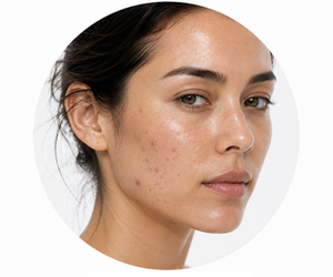 Blemishes & Excess Oil